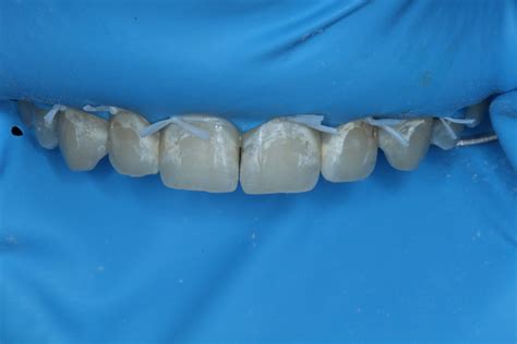 White Spot Lesions: Treatment With Resin Infiltration - Dentistry Today