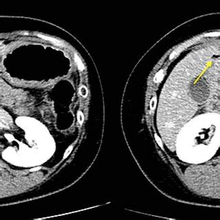 Contrast Enhanced Abdominal Computed Tomography Showing Free Air