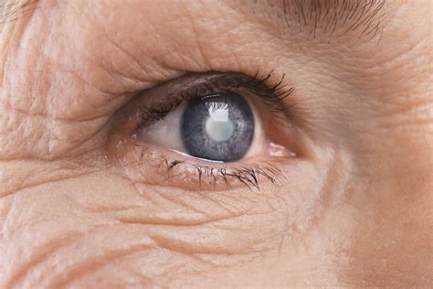 Cataracts Lakeway Eye Physicians And Surgeons Pa