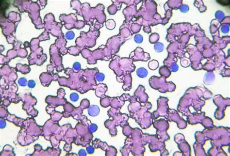 stage  cll treated okkiicom