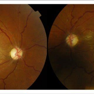 Fundoscopy images of bilateral optic atrophy. A large... | Download Scientific Diagram