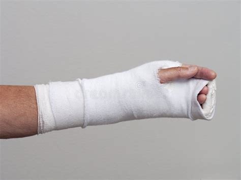 Arm And Hand In Cast And Bandage Stock Photo Image Of Equipment