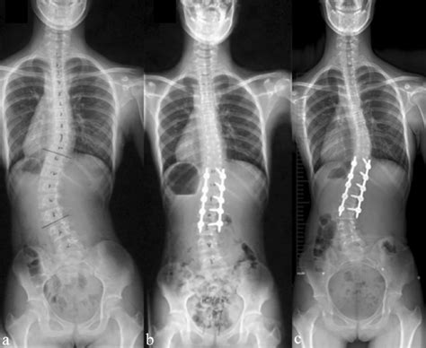 A 13 Year Old Female Lenke 5c Patient With Positive S Line A Download Scientific Diagram