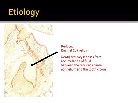 Diagnosis Of Cysts In Oral Cavity PPT