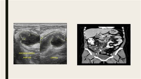 Acute Abdomen Imaging 2pptxacute Abdomen Imaging 2pptxacute Abdomen