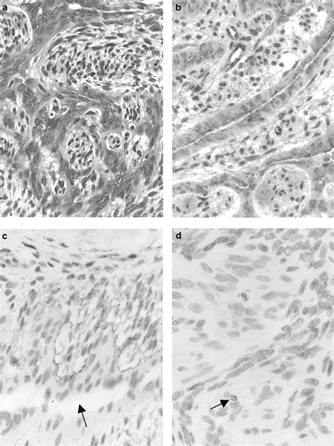 Aberrant Expression Of Tight Junction Related Proteins Zo 1 Claudin 1