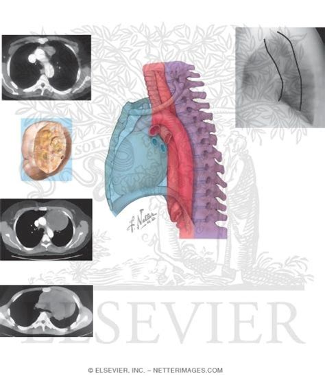 Mediastinal Tumors: Anterior Mediastinum