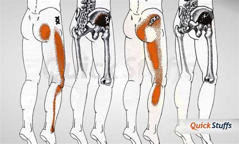 How To Massage Sciatica Trigger Points Quick Stuffs