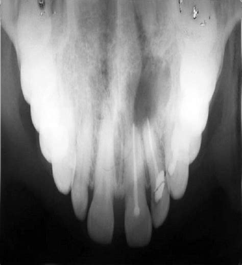 Occlusal Radiograph Showing Diffuse Radiolucency In Left Incisor And Download Scientific