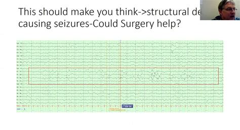 EEG Series: Partial and Generalized Epilepsy » Division of Pediatric ...