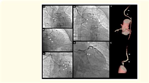 Figure 1 From Percutaneous Treatment Of Chronically Occluded Internal