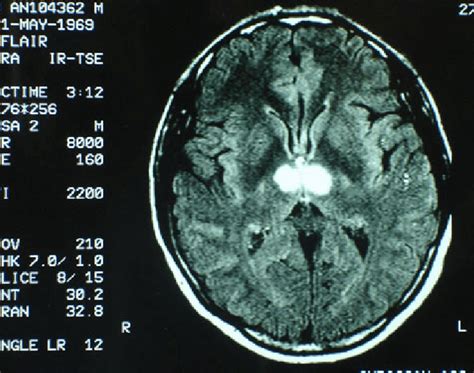 Bilateral thalamic infarction involving the medial group of thalamic... | Download Scientific ...