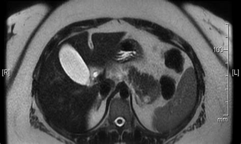 Epidermoid Cyst In An Intra Pancreatic Accessory Spleen Medcrave Online