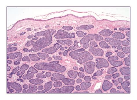 Histopathologic Findings A Low Magnification Of Skin Surface Showing