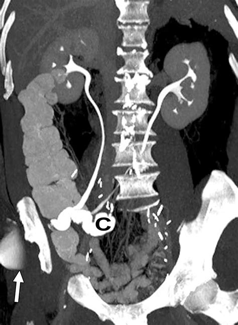 Follow The Stream Imaging Of Urinary Diversions RadioGraphics