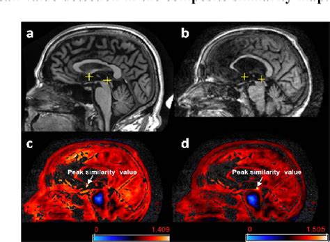 Figure 1 from An Automatic Localization of Anterior Commissure and ...