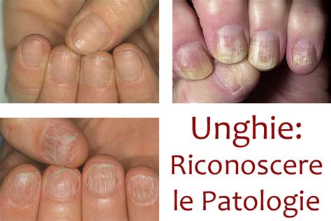 Nailsteps Riconoscere Le Possibili Patologie Delle Unghie