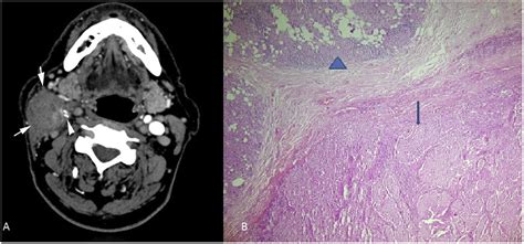 Parotid Gland Involvement As An Initial Presentation Of Papillary