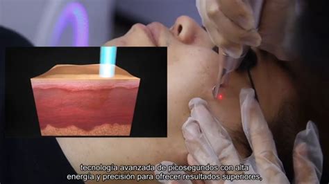 Eliminación de tatuajes rápida y eficaz demostración de la máquina