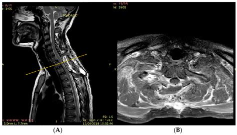 Jcm Free Full Text H3k27 Altered Diffuse Glioma Of The Spinal Cord