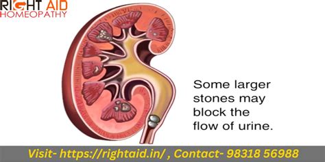 Ppt What Are Kidney Stones Early Warning Signs Or Symptoms Rightaid