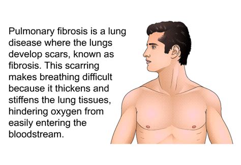 Pulmonary Fibrosis