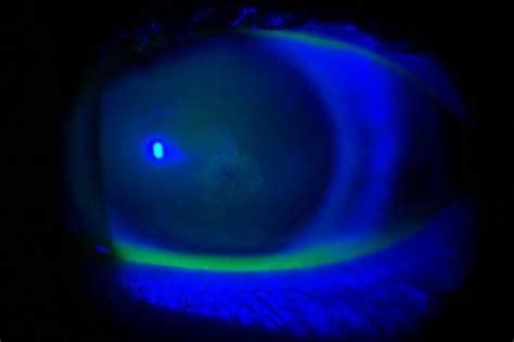 Scleral Lenses Help Dry Eye Patient Cli Nevada