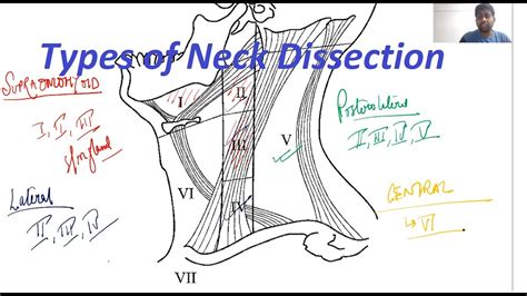 Types Of Neck Dissection General Surgery Lectures Mbbs Ms Dnb