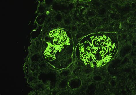 Ajkd Atlas Of Renal Pathology Anti Glomerular Basement Membrane