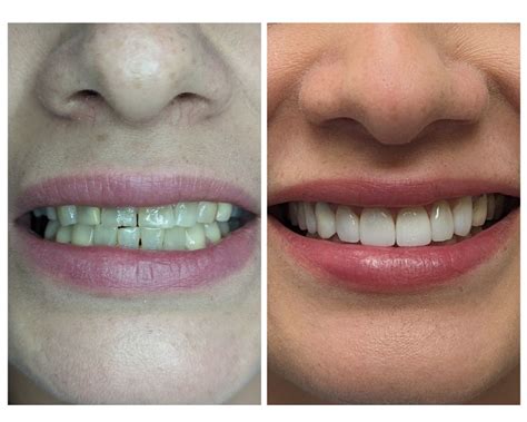 Cosmetic Dentistry Westchester Ny Central Dental