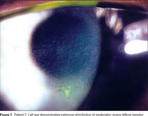 Diffuse Lamellar Keratitis