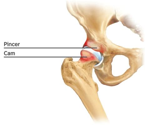 Im Fokus Magazin Impingement Der H Fte