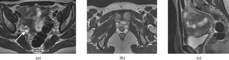 Mullerian Duct Anomalies From Diagnosis To Intervention Abstract