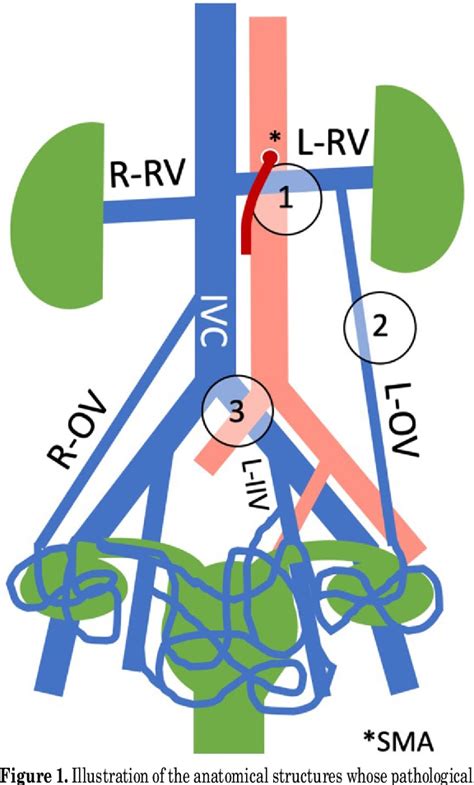 Figure From Definition Of Pelvic Venous Disease And The New Svp