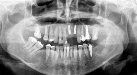 Multidisciplinary Treatment With Implants In The Anterior Aesthetic