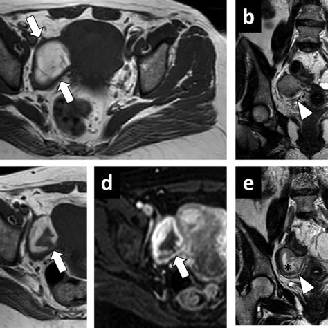 Left Sided Tubo Ovarian Abscess A And B Axial Plane T1w A And T1w Download Scientific