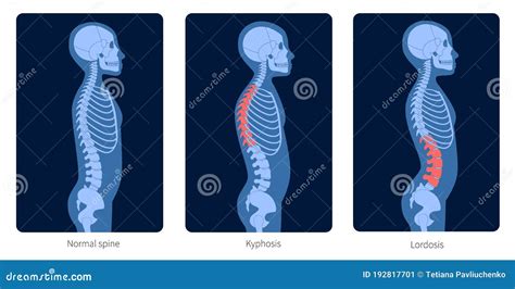 Normal Spine And Spinal Deformity From Scoliosis To Lordosis And