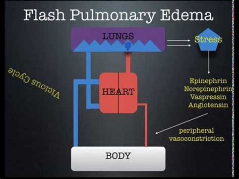 Flash Pulmonary Edema lecture by Dr. Zevallos - YouTube