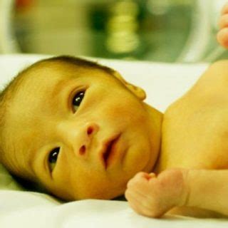 Bebê Com Icterícia Fica Vermelho - ICTERÍCIA NEONATAL: CAUSAS, TRATAMENTO E TEMPO DE DURAÇÃO NO BEBÊ ...