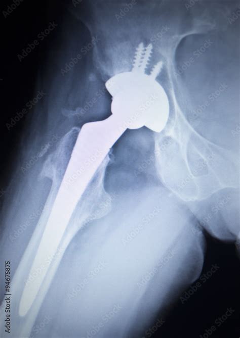 X Ray Scan Image Of Hip Joint Replacement Orthopedic Implant Stock