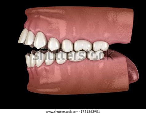 Openbite Dental Occlusion Malocclusion Teeth Medically Stock