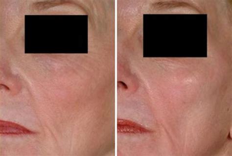 Laser Genesis Before and After photo gallery