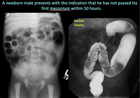 Embryology Gi Birth Defects Flashcards Quizlet