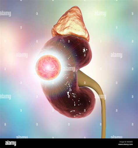 El tratamiento del cáncer renal concepto equipo de ilustración