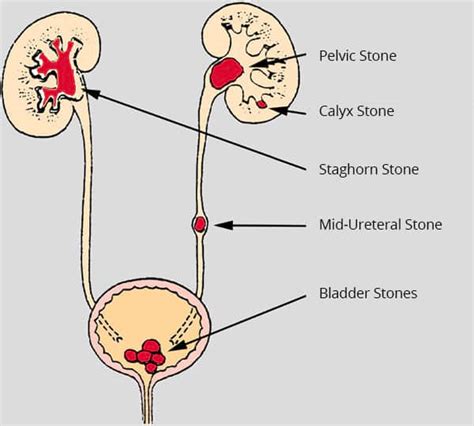 Renal Calculi : Cure through Ayurveda.