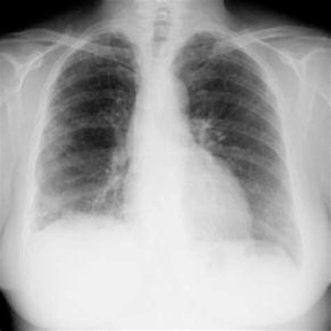 Pdf Fibrosis Pulmonar Idiop Tica Un Reto Para La Atenci N Primaria