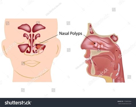 Nasal Polyps Stock Vector (Royalty Free) 125899364