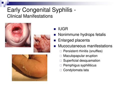 Ppt Congenital Syphilis In Theory And In Reality In Estonia 1991