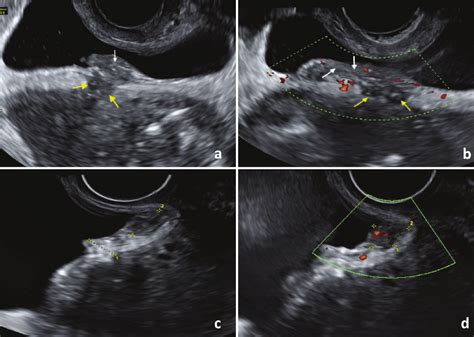 Residual Endometriosis Of The Bladder Wall After Bladder Resection For