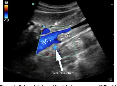 Figure From Thrombosis Of Inferior Vena Cava Diagnosed Using Point Of